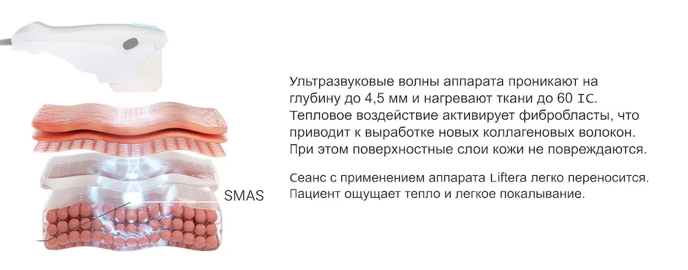 SMAS-лифтинг