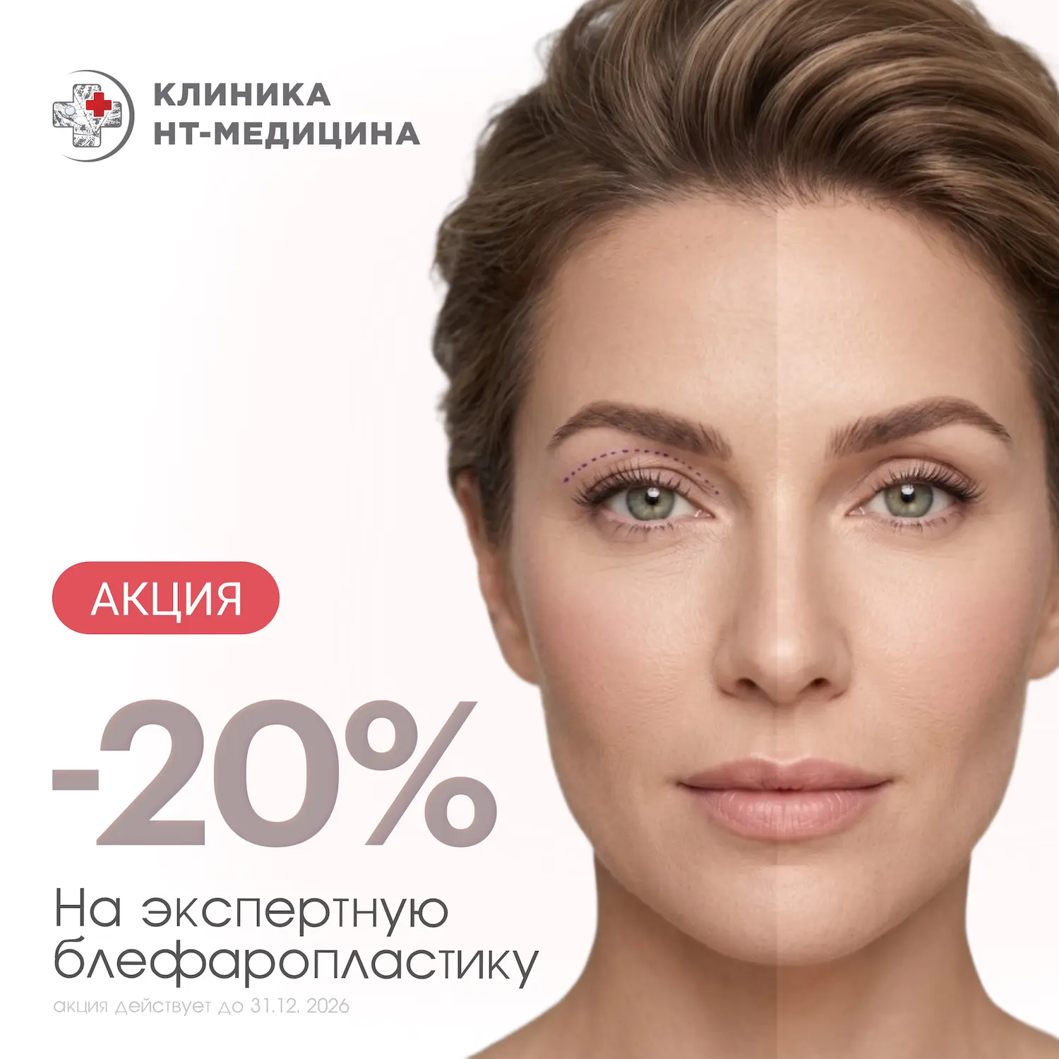 Экспертная блефаропластика в Ярославле от московского пластического хирурга 