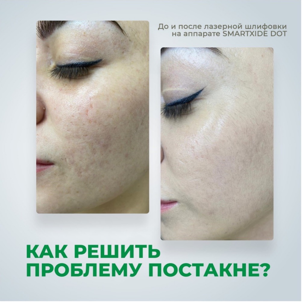 Лечение постакне