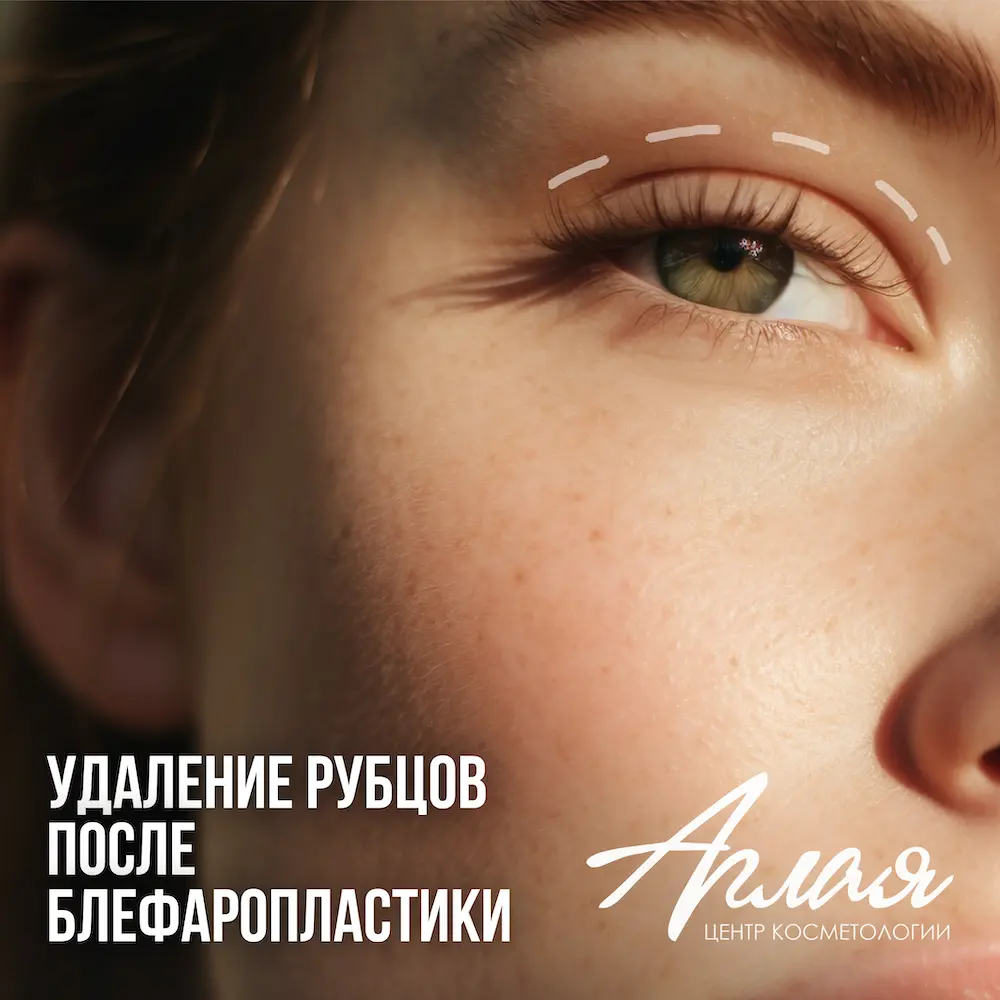 Удаление рубцов после блефаропластики