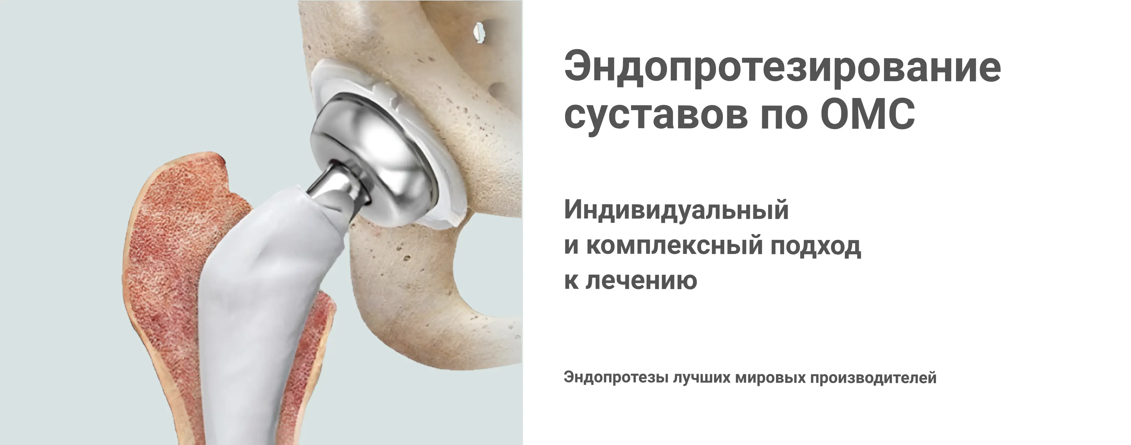 Эндопротезирование по ОМС 