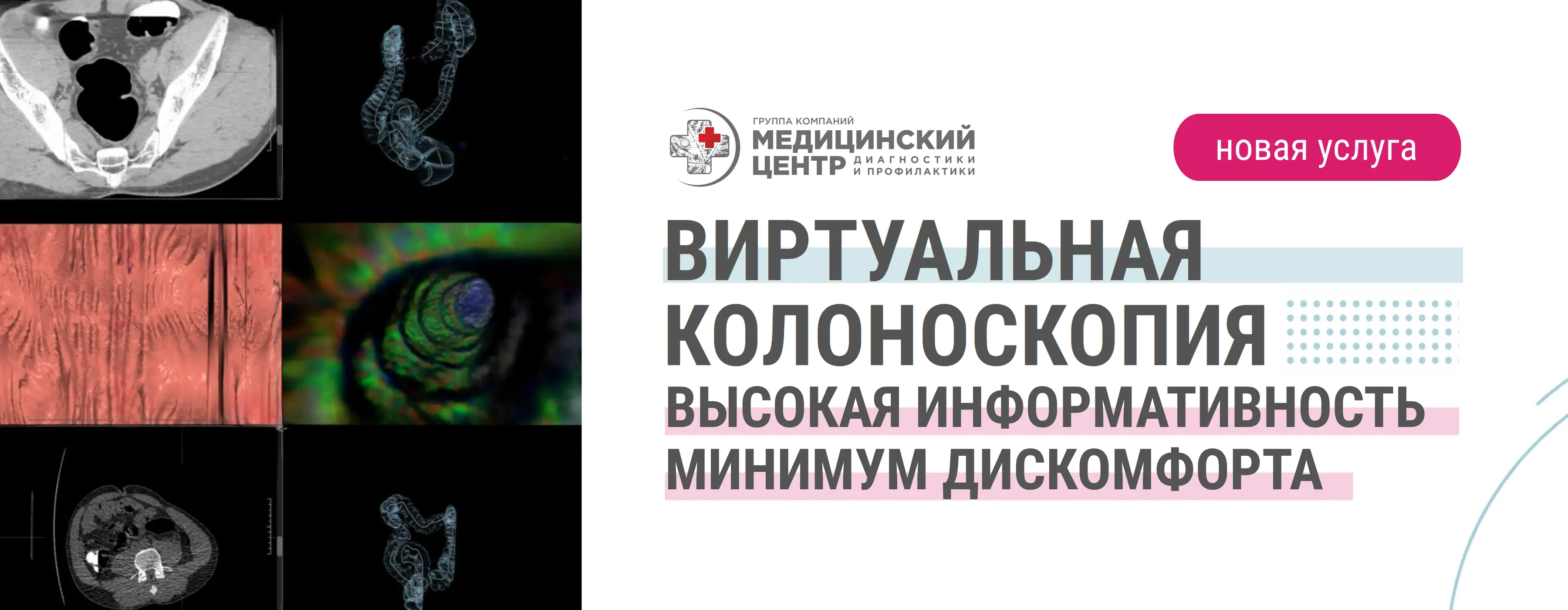 Виртуальная колоноскопия: диагностика без боли и страха