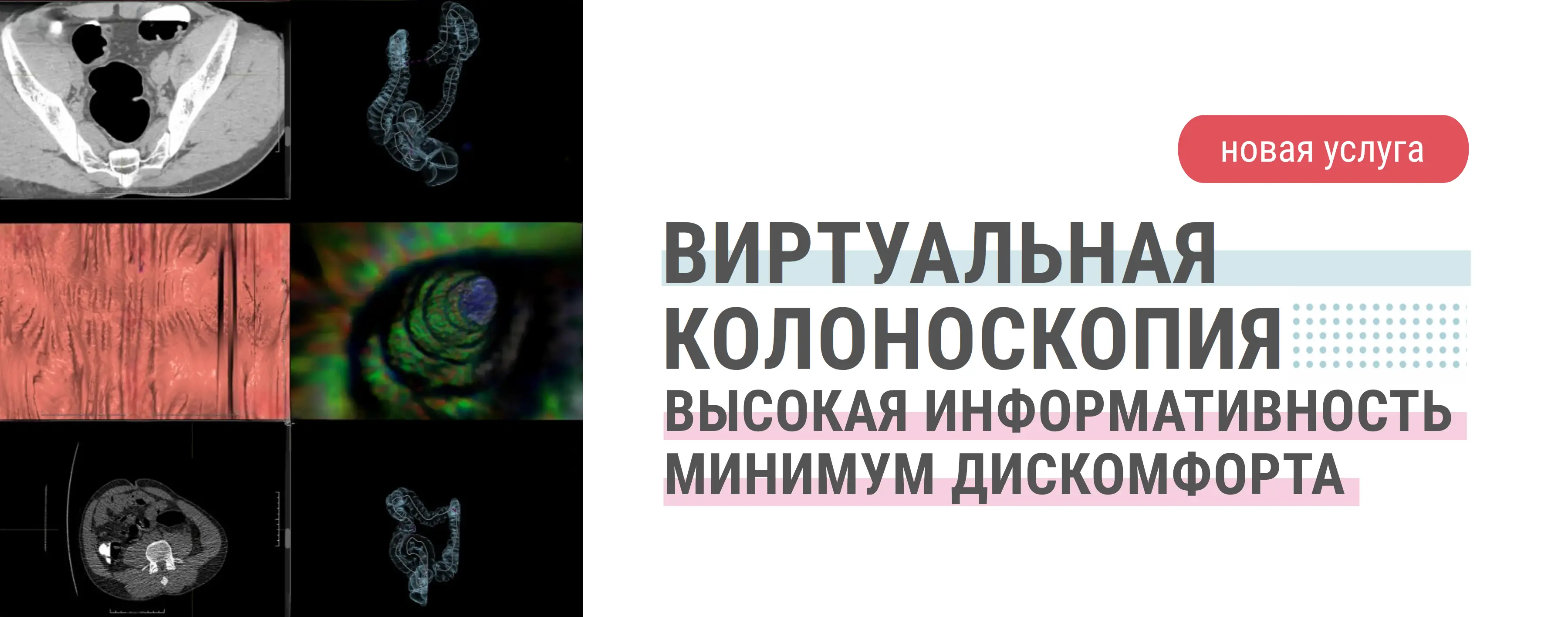 КТ-колоноскопия